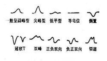 属于心电图5个波段之一.