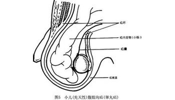 婴儿腹股沟斜疝