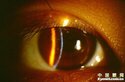 角膜的透明性显得十分重要,影响角膜透明的因素是多方面的,其中角膜炎