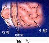 有脐疝,腹股沟直疝,斜疝,切口疝,手术复发疝,白线疝,股疝等种类.