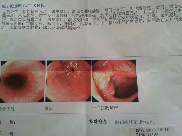 十二指肠球部霜斑样糜烂是怎样引起的,有什么好的药物