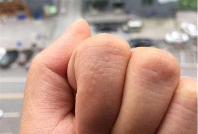 天气回暖,手上就开始长小水泡,而且有点痒,该怎