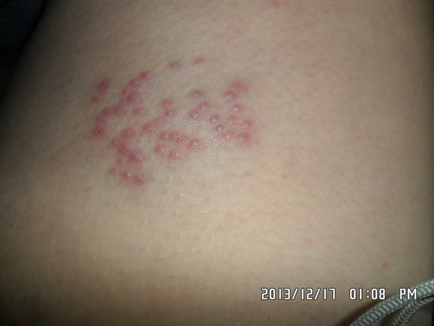 01.29 0 带状疱疹是由水痘-带状疱疹病毒引起的急性感染性皮肤病.