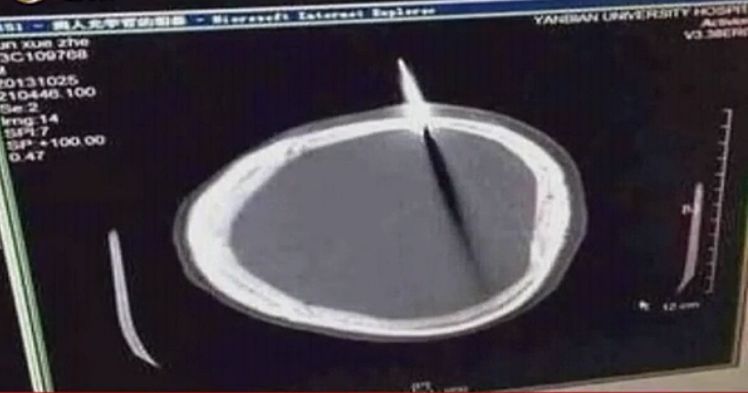 男子头插水果刀淡定就医,医生询问原因后让人哭笑不得