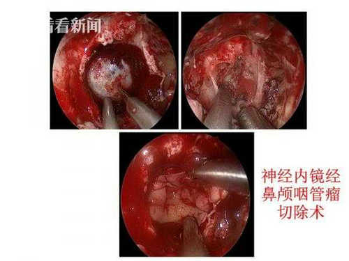 国内首例经鼻内窥镜下儿童颅咽管瘤切除手术成功