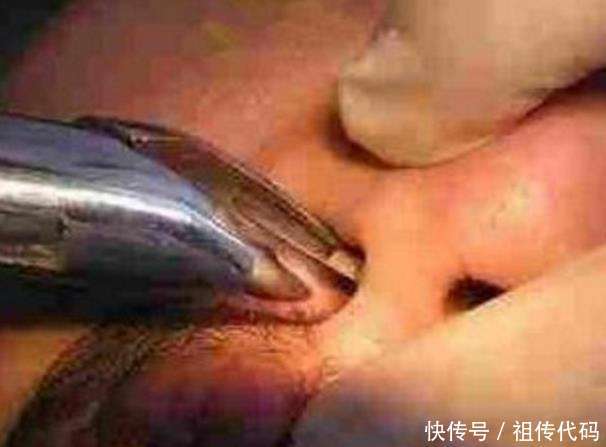 男子鼻子里长了20年的异物, 近来时痛时痒, 医生拔出后却看