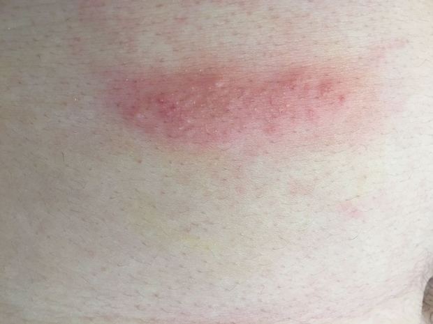 皮肤红起来一块 表面带有细小的小水泡 很痒 抓