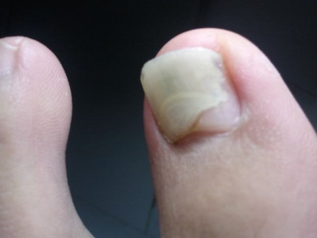 宝宝脚趾甲白斑图片图片_纵览新闻