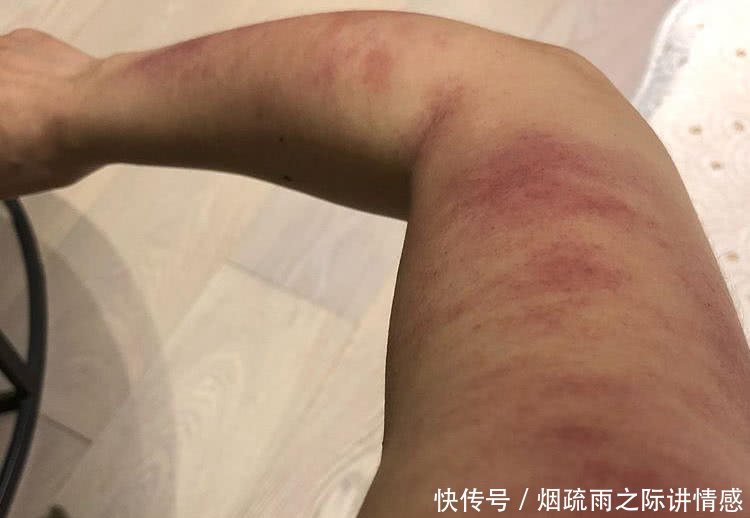 杨丞琳理疗身体之后出痧不减,手臂红肿让人心