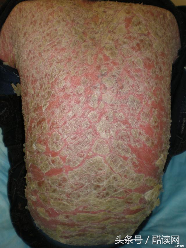 AIDS患者Gaetan Dugas,我想大家和我一起死·