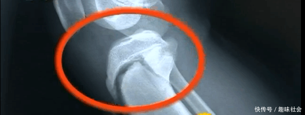 一场篮球赛差点让13岁男童停止长高