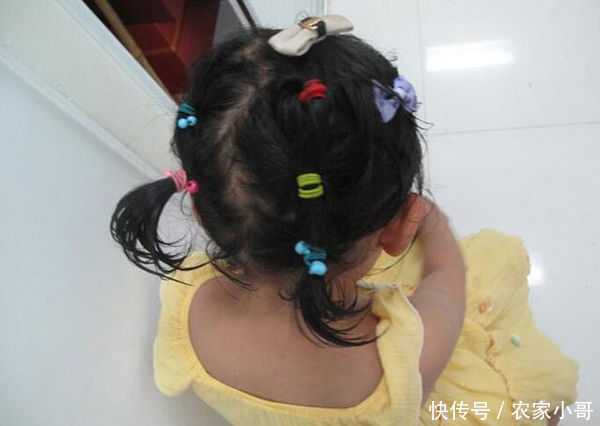 4岁女儿突然掉头发,妈妈带去医院检查,医生:把