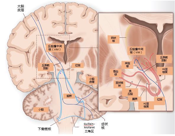 特发性震颤首选用药有哪些?看看最新 NEJM 综述怎么说