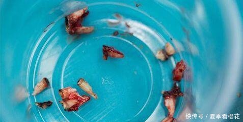 四岁男孩一次拔13颗牙, 起因只是一个小习惯