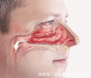 教你如何正确识别鼻甲肥大