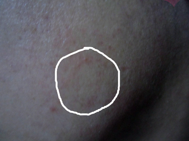 并注意与硬性下疳