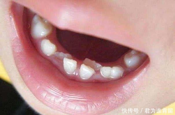 孩子几岁后,开始换牙属于正常?男孩和女孩有