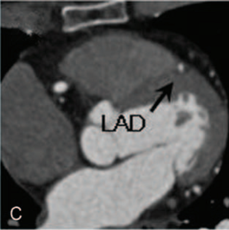 屋漏偏逢连夜雨，心肌致密化不全合并心肌桥