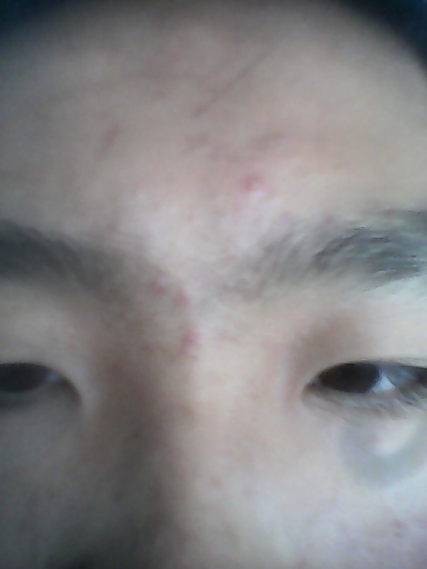 螨虫引起的皮肤病