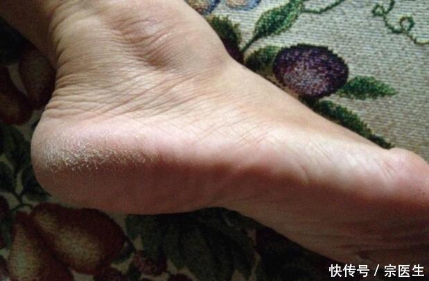 女人脚后跟干裂怎么回事?春天脚丫又白又嫩,秘
