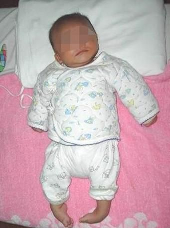 怀胎十月生下的二胎孩子竟是脑瘫!脑瘫儿的症