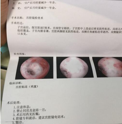 怀疑是子宫腔粘连 宫腔镜检查费用大概是多少