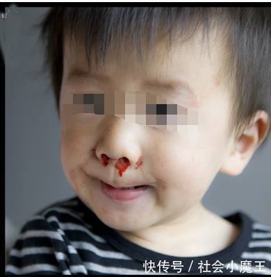 2岁孩子流鼻血离世,检查结果让人吃惊,因为90