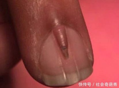 男子指甲盖上长出小指甲,去医院检查,引发国际医学界关注