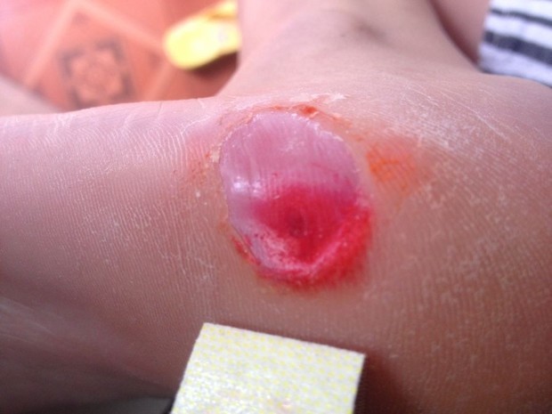 鸡眼什么样子才是去除了?_360问答