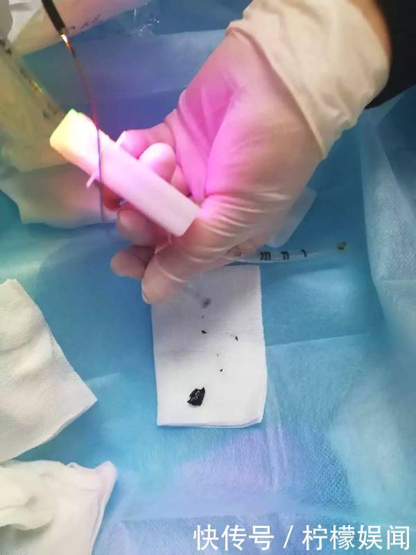 1岁男孩吃板栗险丧命!家里有宝宝的尤其注意了