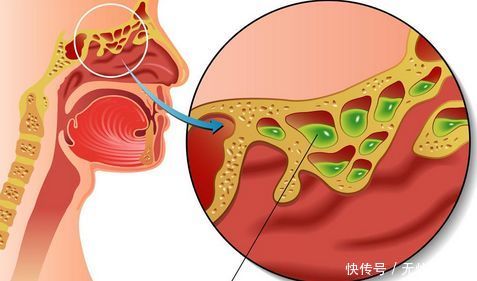 鼻窦炎危害大,尽早治疗很重要
