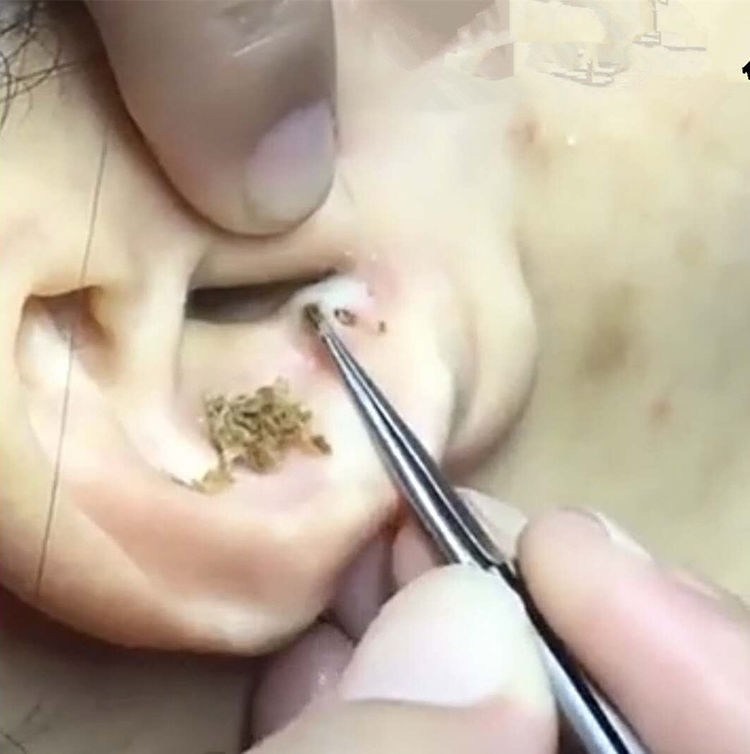 男子耳朵长了一个黑头,疼痛难忍,医生夹出后,男