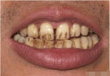抽烟的人牙齿为什么更容易发黑?