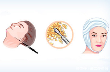 韩国面部吸脂案例对比