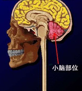 小脑星形细胞瘤