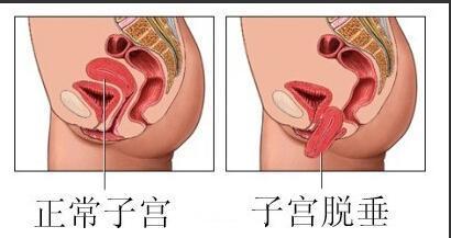 子宫<em>下垂</em>的症状图_360问答