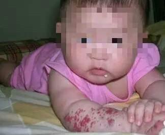 刚出生宝宝身上出现红点,无知妈妈没在意,到医