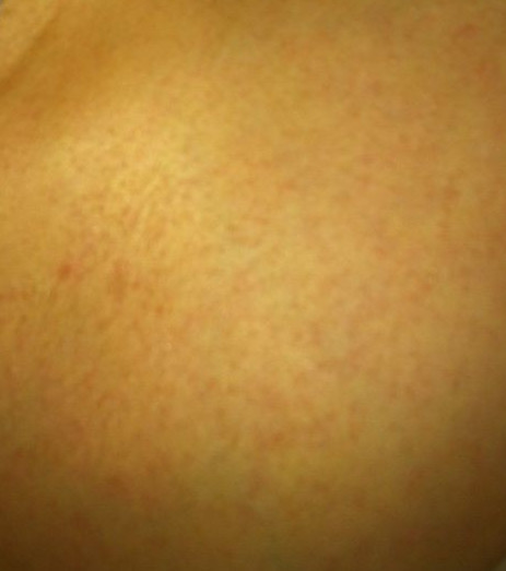 胳膊上长红点点是怎么回事 t01be9452ce0fd37f5a.jpg