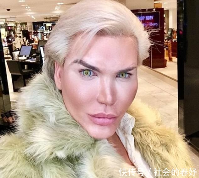 巴西整容狂人又做了头发移植,成功约上了女星