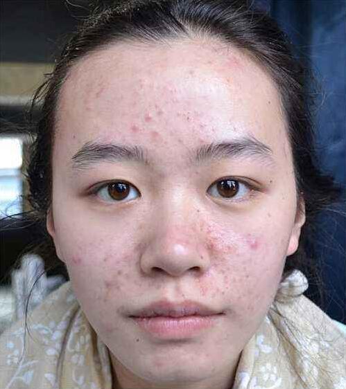 有种痘痘叫螨虫痘,5个现象告诉你是不是,有些