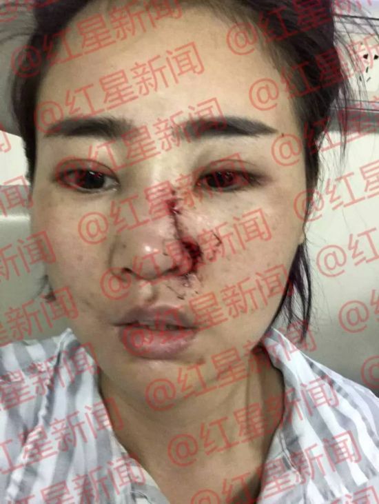 2cm,以上三项都是轻伤二级."