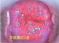 <em>女性</em>患了宫颈糜烂怎么办?_360问答