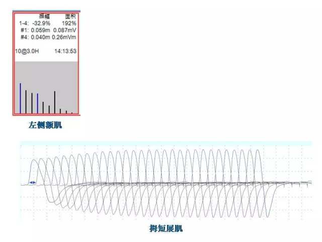 爱美须有度!「瘦腿针」带来的急性全身肌无力