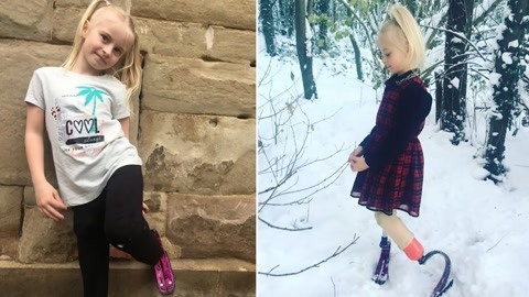 涨健识 漂亮女孩截肢后活出精彩