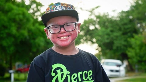 涨健识 少年患病皮肤不停脱落，像红骷髅笑容却依然灿烂