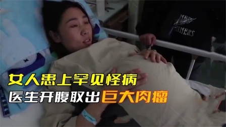 单亲妈妈患上罕见怪病，医生做手术时，取出巨大的肉瘤
