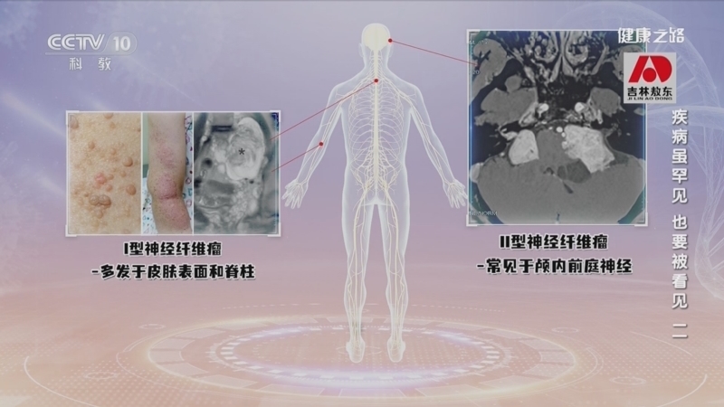 健康之路 《健康之路》 20230223 疾病虽罕见 也要被看见（二）