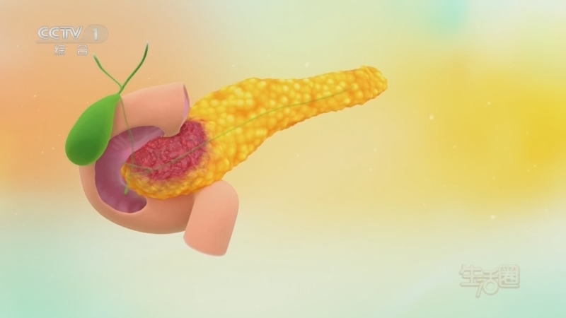 《生活圈》 20251031 护好胰腺 远离“癌王”