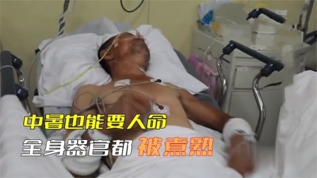 一位厨师在夏天工作，导致全身的器官都被煮熟，医生全力抢救