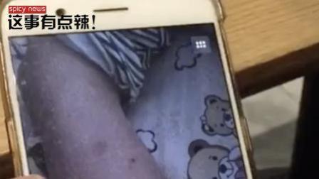 新闻辣一度 多名幼童身上现红点，称老师用牙签扎